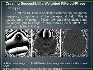 Creating Susceptibility-Weighted Filtered-Phase
   Images
         First, an HP filter is applied to remove the low-spatial
  frequency components of the background field. This is
  usually done by using a 64X64 low-pass filter divided into
  the original phase image to create an HP-filter effect. The
  end result is the HP filter.




A, Raw phase image.;      B, HP-filtered phase image with a central filter size of
32x32;
C, Filtered-phase image with a central filter size of 64x64.
 