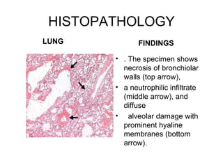 HISTOPATHOLOGY
LUNG           FINDINGS

        • . The specimen shows
          necrosis of bronchiolar
          walls (top arrow),
        • a neutrophilic infiltrate
          (middle arrow), and
          diffuse
        • alveolar damage with
          prominent hyaline
          membranes (bottom
          arrow).
 