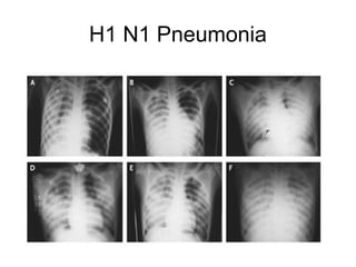 H1 N1 Pneumonia
 