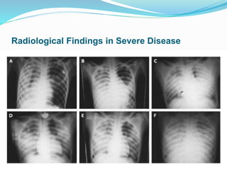 Radiological Findings in Severe Disease
 