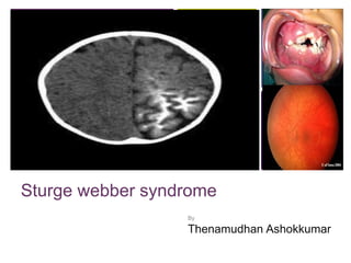+
Sturge webber syndrome
By
Thenamudhan Ashokkumar
 