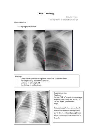 CHEST Radiology
                                                                          อ.พญ.วิรณา อางทอง
                                                ภาควิชารังสีวิทยา มหาวิทยาลัยศรีนครินทรวิโรฒ
1.Pneumothorax.

   1.2 Simple pneumothorax.




 Findings:
    - There is thin white visceral pleural line at left side hemithorax.
    - No lung marking distal to visceral line.
    - Collapse of left lung field.
    - No shifting of mediastinum.



                                                      Deep sulcus sign
                                                      Findings:
                                                      Supine CXR of neonate demonstrates
                                                      abnormal deepening and lucency of
                                                      the left lateral costophrenic
                                                      angle.

                                                      Pneumothorax ในทานอน airจะลอยขึ้นมาใน
                                                      สวนnondependent portionของpleural
                                                      cavity ซึ่งคือตําแหนงlateral costophrenic
                                                      angle ทําใหบริเวณดูดําลงและขยายลึกลงมาทางดาน
                                                      ทองมากขึ้น
 