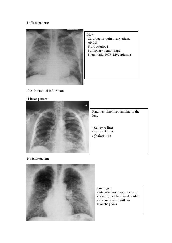 SWU CXR interpretation