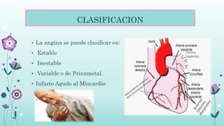 CLASIFICACION
• La angina se puede clasificar en:
• Estable
• Inestable
• Variable o de Prinzmetal.
• Infarto Agudo al Miocardio
 