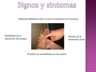 Hipersensibilidad sobre el nervio mediano en la muñeca Debilidad de la oposición del pulgar Atrofia de la eminencia tenar Pérdida de sensibilidad en los dedos  