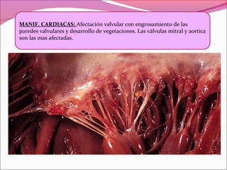 MANIF. CARDIACAS: Afectación valvular con engrosamiento de las
paredes valvulares y desarrollo de vegetaciones. Las válvulas mitral y aortica
son las mas afectadas.
 