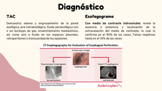 Diagnóstico
Demuestra: edema y engrosamiento de la pared
esofágica, aire extraesofágico, fluido periesofágico con
o sin burbujas de gas, ensanchamiento mediastínico,
así como aire o fluido en los espacios pleurales,
retroperitoneo o transcavidad de los epiplones
TAC
Con medio de contraste hidrosoluble: revela la
ausencia o presencia y localización de la
extravasación del medio de contraste, lo cual lo
confirma en el 90% de los casos. Falsos negativos
hasta en el 10% de las veces
Esofagograma
 
