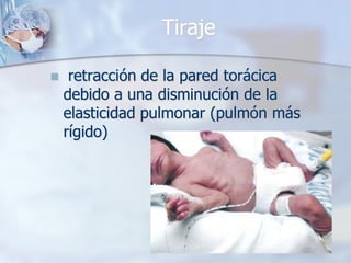 Tiraje

    retracción de la pared torácica
    debido a una disminución de la
    elasticidad pulmonar (pulmón más
    rígido)
 