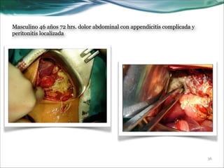 Masculino 46 años 72 hrs. dolor abdominal con appendicitis complicada y
peritonitis localizada

!36

 