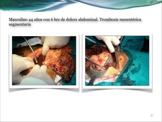 Masculino 44 años con 6 hrs de dolors abdominal. Trombosis mesentérica
segmentaria

!37

 
