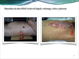 Masculino 36 años HPAF Lesion de hígado, estómago, colon y páncreas

!38

 