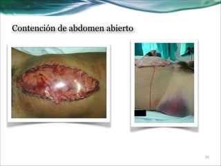Contención de abdomen abierto

!39

 