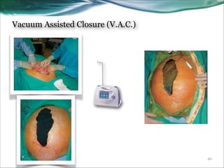 Vacuum Assisted Closure (V.A.C.)

!40

 