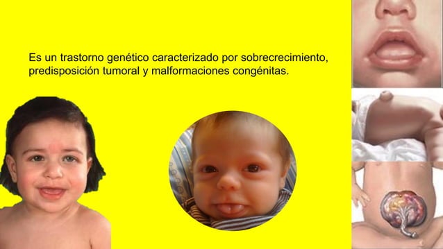 Sindrome de beckwith wiedemann | PDF | Genetics | Science
