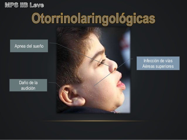 Sindrome de Hunter (mucopolisacaridosis tipo 2) Sindrome de Hunter (mucopolisacaridosis tipo 2)