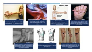 Crecimiento lineal excesivo de los
huesos largos y la laxitud articular.
Movilidad articular reducida,
particularmente del codo y los
dedos.
Tienen extremidades
desproporcionadamente largas en
comparación con la longitud del tronco, o
dolicostenomelia.
Aracnodactilia con un signo del pulgar
positivo donde la falange distal entera
sobresale más allá del borde cubital de un
puño cerrado.
Muestran un signo de muñeca positivo donde
la parte superior del pulgar cubre toda la uña
del quinto dedo cuando se envuelve alrededor
de la muñeca contralateral.
Exhiben pectus carinatum o pectus
excavatum.
La deformidad del pie plano, causada por
la laxitud ligamentaria, conduce a pies más
largos y más estrechos que la persona
promedio.
 