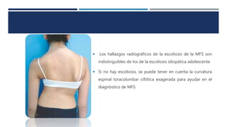  Los hallazgos radiográficos de la escoliosis de la MFS son
indistinguibles de los de la escoliosis idiopática adolescente
 Si no hay escoliosis, se puede tener en cuenta la curvatura
espinal toracolumbar cifótica exagerada para ayudar en el
diagnóstico de MFS
 