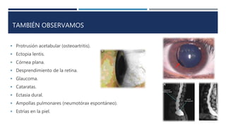 TAMBIÉN OBSERVAMOS
 Protrusión acetabular (osteoartritis).
 Ectopia lentis.
 Córnea plana.
 Desprendimiento de la retina.
 Glaucoma.
 Cataratas.
 Ectasia dural.
 Ampollas pulmonares (neumotórax espontáneo).
 Estrías en la piel.
 