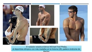 El nadador estadounidense Michael Fred Phelps,
el deportista olímpico con más medallas en la historia (28), padece síndrome de
 