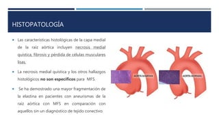 HISTOPATOLOGÍA
 Las características histológicas de la capa medial
de la raíz aórtica incluyen necrosis medial
quística, fibrosis y pérdida de células musculares
lisas.
 La necrosis medial quística y los otros hallazgos
histológicos no son específicos para MFS.
 Se ha demostrado una mayor fragmentación de
la elastina en pacientes con aneurismas de la
raíz aórtica con MFS en comparación con
aquellos sin un diagnóstico de tejido conectivo.
 