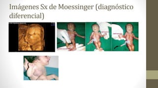 Imágenes Sx de Moessinger (diagnóstico
diferencial)
 