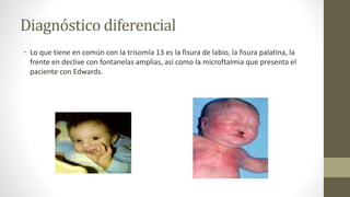 Diagnóstico diferencial
• Lo que tiene en común con la trisomía 13 es la fisura de labio, la fisura palatina, la
frente en declive con fontanelas amplias, así como la microftalmia que presenta el
paciente con Edwards.
 