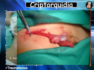 CriptorquidiaClasificaciónDiagnosticoTerapéuticoCriptorquidia (cavidad abdominal) Testículo no descendido verdaderoPalpablesNo PalpablesEtiología  TEORIAS Ausencia de receptores 