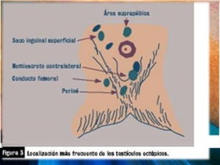  Anormalidades del epidídimoCriptorquidiaManifestaciones Clínicas. Ausencia del testículo en la bolsa escrotal