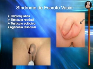 Síndrome de Escroto Vacio Criptorquidias 