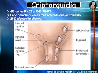 Agenesia testicular FisiologíaFactores Hormonales: 4º Semana  Se individualizan las crestas y se colonizan con células germinales. 7º Semana  Secreción de testosterona y hormona antimulleriana (GCH)  Conductos de Wolf en epidídimos y deferentes. 8º y 16º Semana  Testosterona.Factores mecánicos: fijación del gubernaculum y presión abdominal (Migración transabdominal e inguinoescrotal)