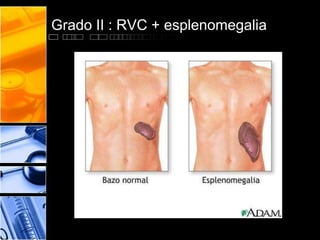 Grado III: RVC + E +várices esofágicas
 