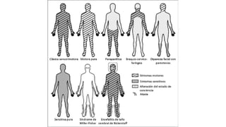 Sindrome de Landry-Guillain-Barré-Strohl | PDF