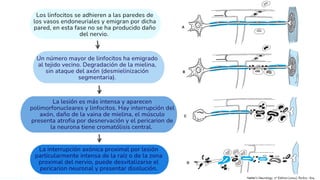 Sindrome de Landry-Guillain-Barré-Strohl | PDF