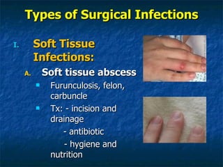 Types of Surgical Infections Soft Tissue Infections: Soft tissue abscess Furunculosis, felon, carbuncle Tx: - incision and drainage   - antibiotic   - hygiene and nutrition 