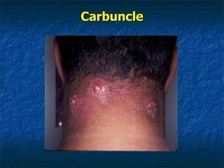 Carbuncle 