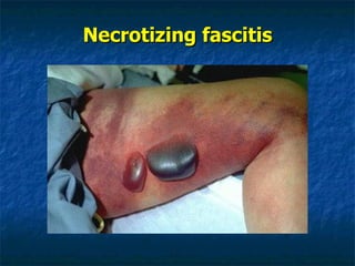 Necrotizing fascitis 