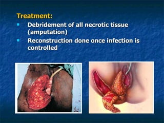 Treatment: Debridement of all necrotic tissue (amputation) Reconstruction done once infection is controlled 