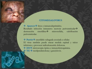 CITOMEGALOVIRUS
 Aparece fetos e inmunodeprimidos.
Resultado infección intrautero: necrosis periventricular
destrucción encefálica microcefalia, calcificación
periventricular.
 Patrón encefalitis subaguda asociada a células
El virus también puede atacar medula espinal y raíces
inferiores y provocar radiculoneuritis dolorosa.
 DX microscopia óptica e inmunohistoquimica.
 TX  metilprednisolona y ganciclovir.
 