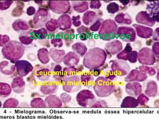 Sx mieloproliferativos
Leucemia mieloide Aguda
Leucemia mieloide Crónica
 