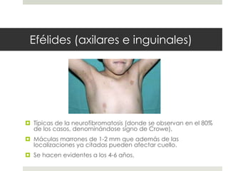 Efélides (axilares e inguinales)
 Típicas de la neurofibromatosis (donde se observan en el 80%
de los casos, denominándose signo de Crowe),
 Máculas marrones de 1-2 mm que además de las
localizaciones ya citadas pueden afectar cuello.
 Se hacen evidentes a los 4-6 años.
 
