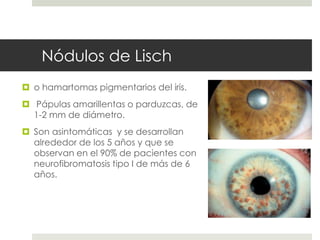 Nódulos de Lisch
 o hamartomas pigmentarios del iris.
 Pápulas amarillentas o parduzcas, de
1-2 mm de diámetro.
 Son asintomáticas y se desarrollan
alrededor de los 5 años y que se
observan en el 90% de pacientes con
neurofibromatosis tipo I de más de 6
años.
 