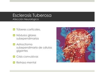 Esclerosis Tuberosa
Afección Neurológica
 Túberes corticales.
 Nódulos gliares
subependimarios
 Astrocitoma
subependimario de células
gigantes
 Crisis convulsivas
 Retraso mental
 