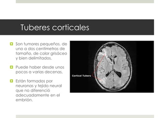 Tuberes corticales
 Son tumores pequeños, de
uno a dos centímetros de
tamaño, de color grisáceo
y bien delimitados.
 Puede haber desde unos
pocos a varias decenas.
 Están formados por
neuronas y tejido neural
que no diferenció
adecuadamente en el
embrión.
 