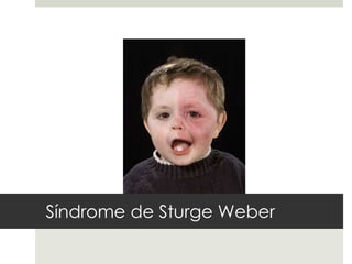 Síndrome de Sturge Weber
 