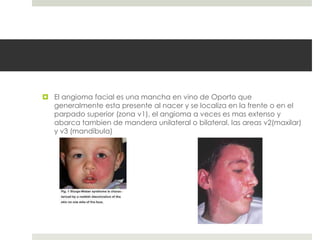  El angioma facial es una mancha en vino de Oporto que
generalmente esta presente al nacer y se localiza en la frente o en el
parpado superior (zona v1), el angioma a veces es mas extenso y
abarca tambien de mandera unilateral o bilateral, las areas v2(maxilar)
y v3 (mandíbula)
 