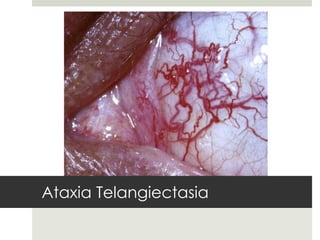Ataxia Telangiectasia
 