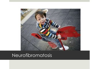 Neurofibromatosis
 