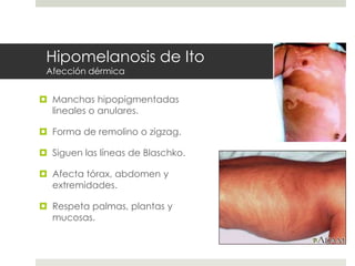 Hipomelanosis de Ito
Afección dérmica
 Manchas hipopigmentadas
lineales o anulares.
 Forma de remolino o zigzag.
 Siguen las líneas de Blaschko.
 Afecta tórax, abdomen y
extremidades.
 Respeta palmas, plantas y
mucosas.
 