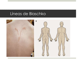 Líneas de Blaschko
 