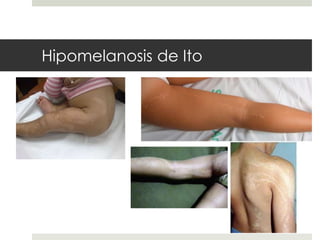 Hipomelanosis de Ito
 